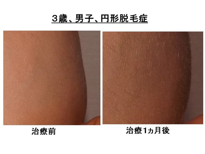円形脱毛症　病院""